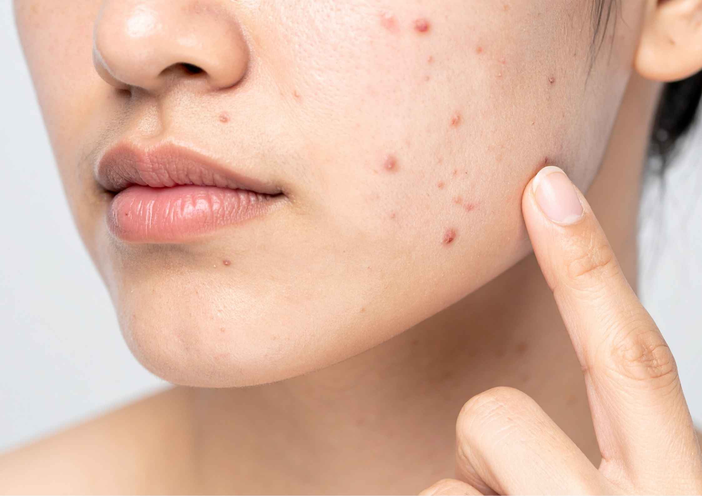 Alasan Makeup Bisa Memperparah Jerawat dan Cara Mengatasinya