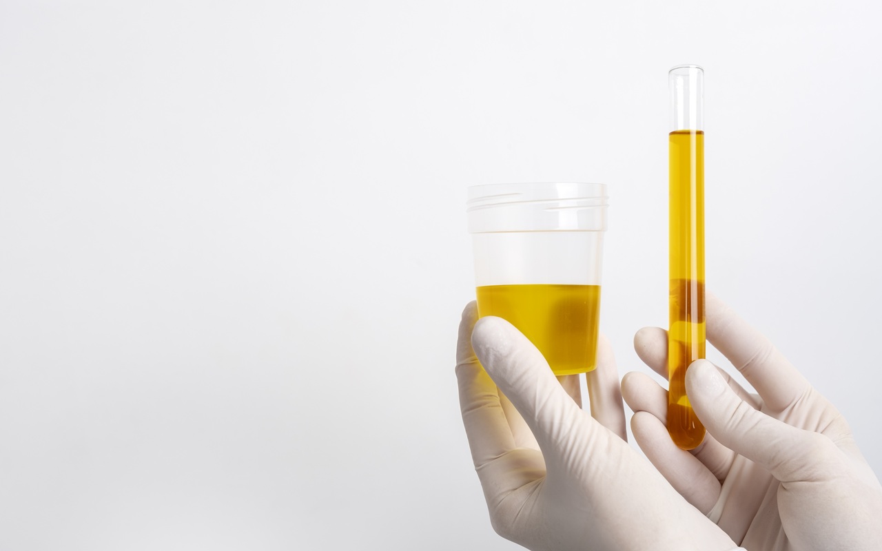 Studi Baru: Tes Urine GALEAS Bladder Deteksi 92,2 Persen Kasus Kanker Kandung Kemih