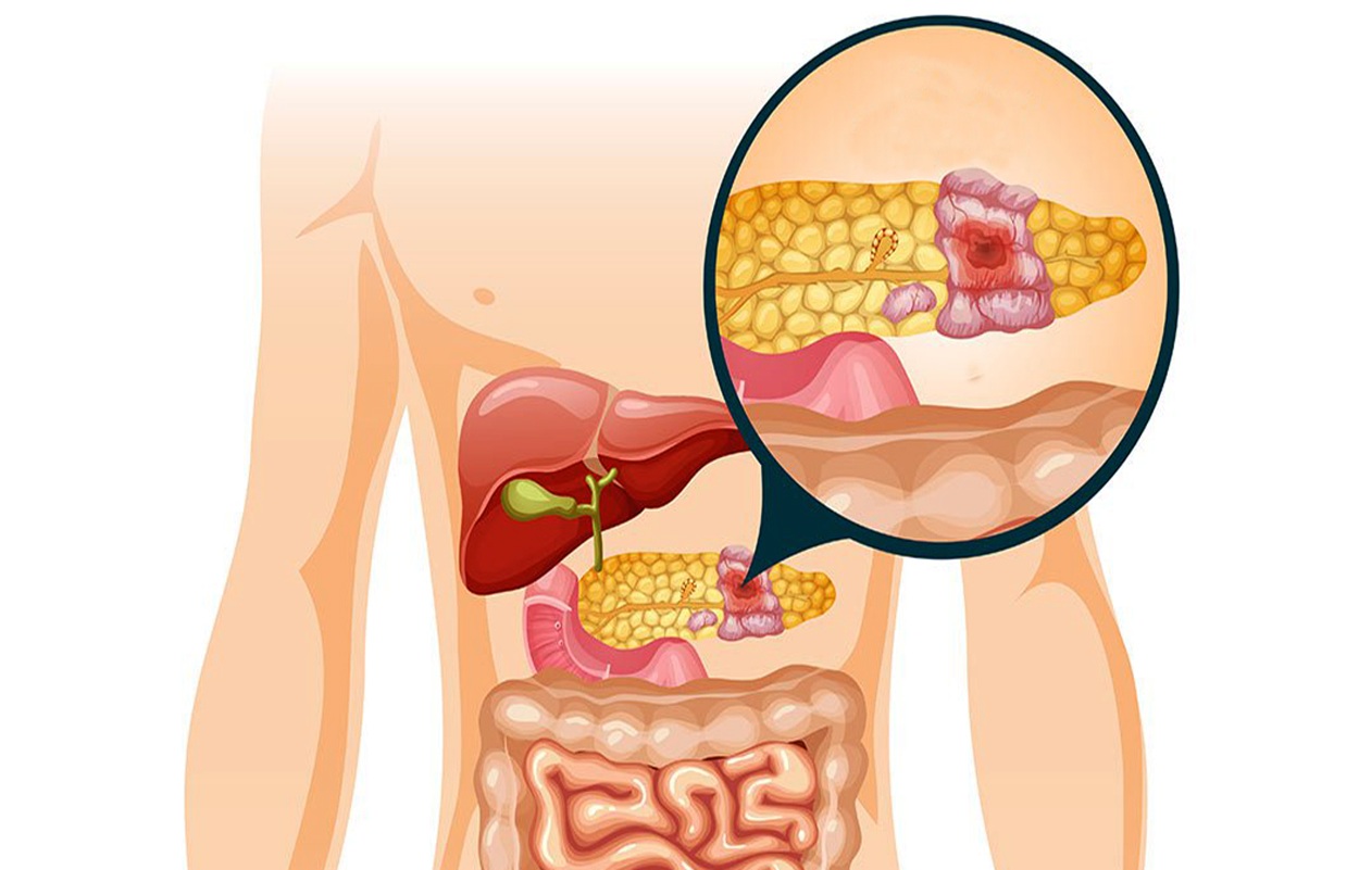 Studi SNUBH Ungkap Dua Strategi untuk Kurangi Risiko Diabetes dan Hati Berlemak Usai Operasi Pankreas