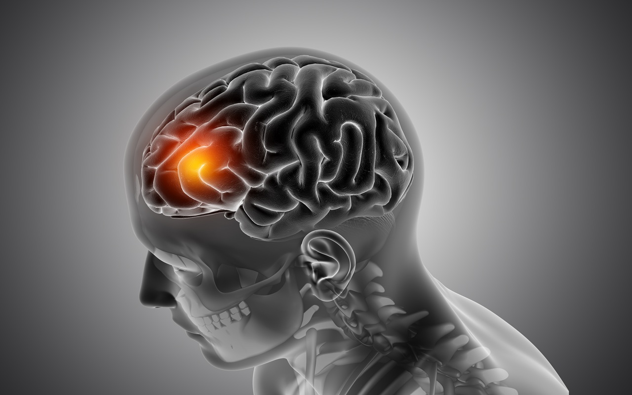 Ilmuwan Ungkap Cara APOE4 Merusak Pembuluh Darah Otak pada Penyakit Alzheimer