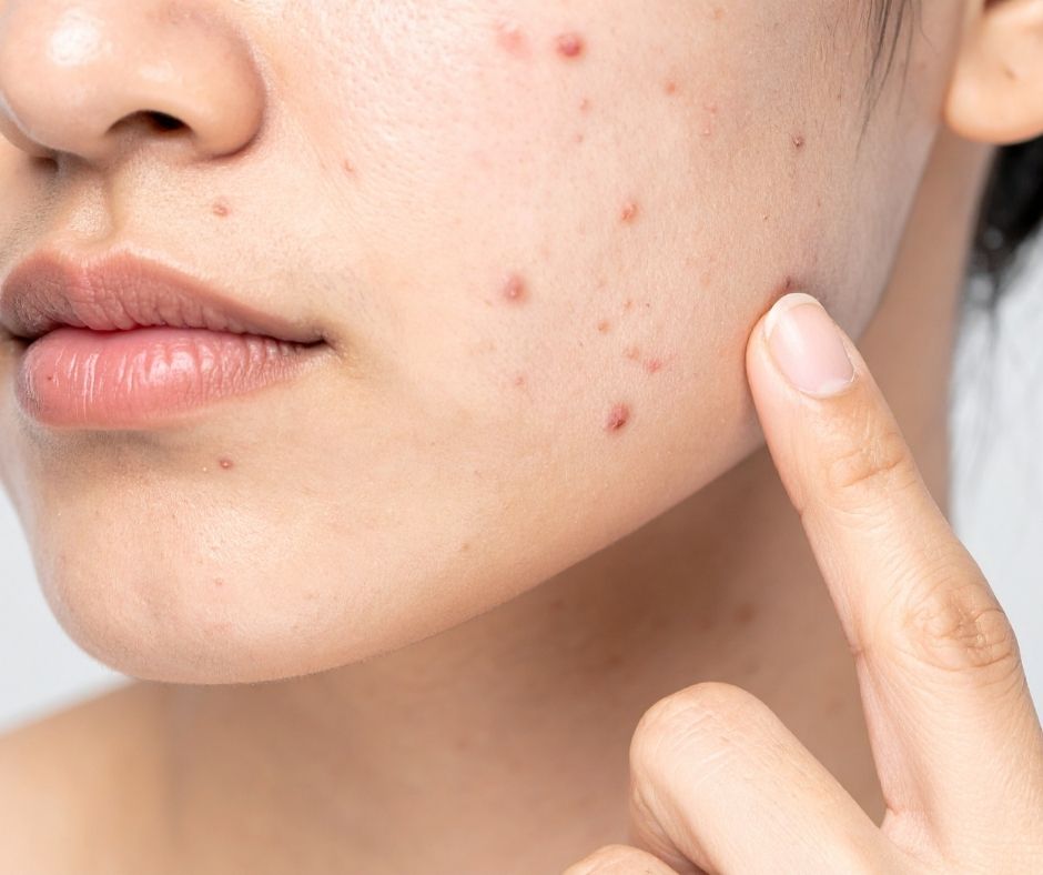 Panduan Makeup Aman untuk Kulit Berjerawat