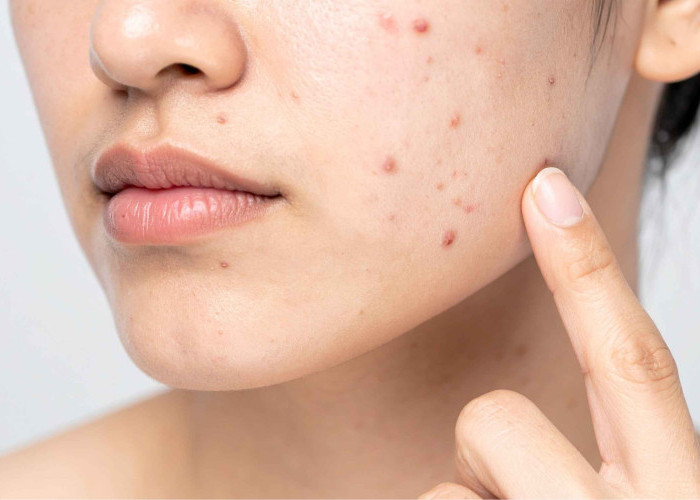 Kenapa Jerawat Muncul? Ini Makanan yang Harus Diwaspadai