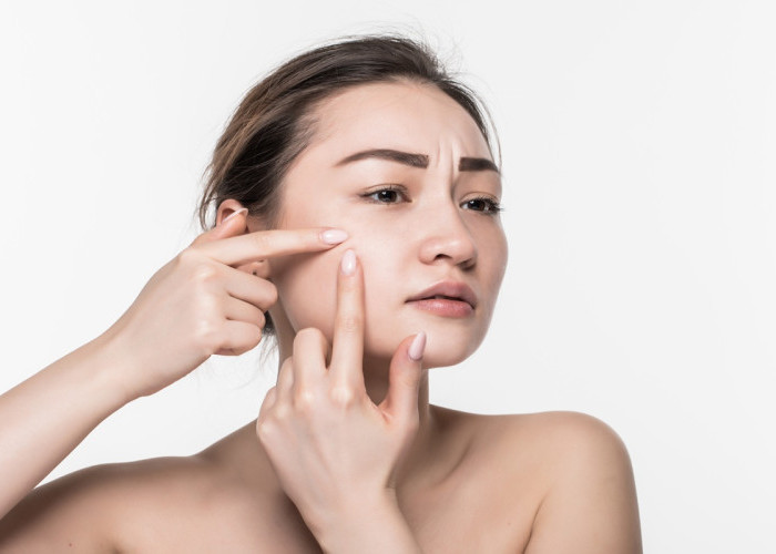 Jerawat Tak Kunjung Hilang? Ini 4 Cara Ampuh Mengatasi Jerawat Membandel Menurut Dokter