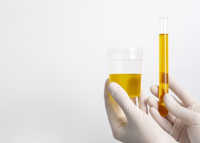 Studi Baru: Tes Urine GALEAS Bladder Deteksi 92,2 Persen Kasus Kanker Kandung Kemih