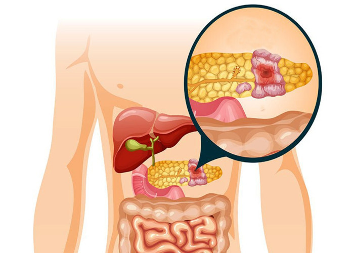 Studi SNUBH Ungkap Dua Strategi untuk Kurangi Risiko Diabetes dan Hati Berlemak Usai Operasi Pankreas