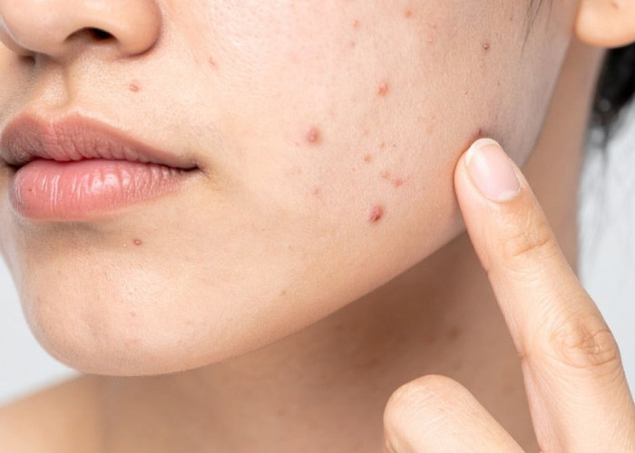 Panduan Makeup Aman untuk Kulit Berjerawat